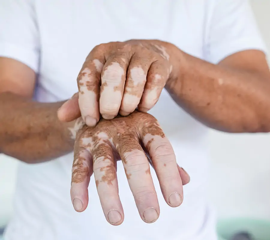Functional Medicine Approach to Vitiligo