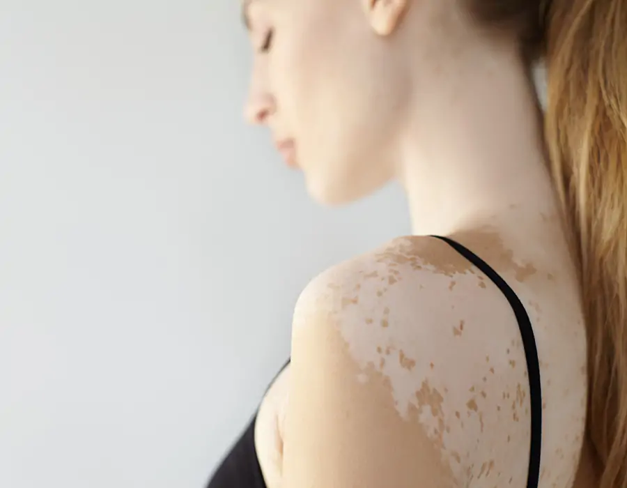 Comprehensive Vitiligo Treatment