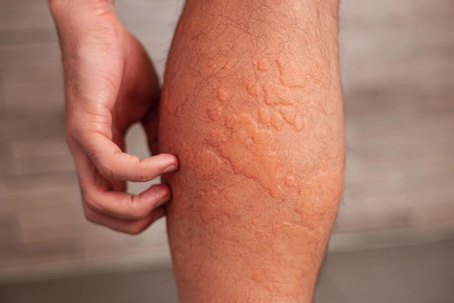 Child experiencing allergy-related symptoms
