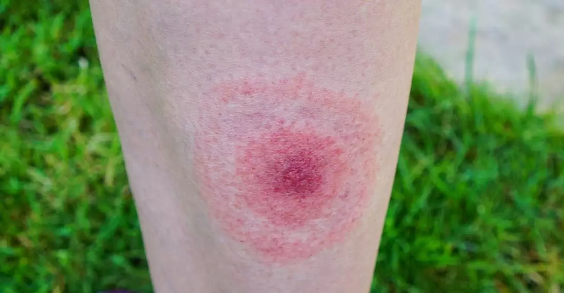 Lyme Disease